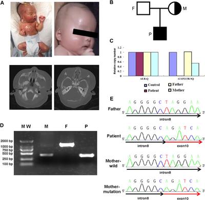 Identification of the first congenital ichthyosis case caused by a homozygous deletion in the ALOX12B gene due to chromosome 17 mixed uniparental disomy